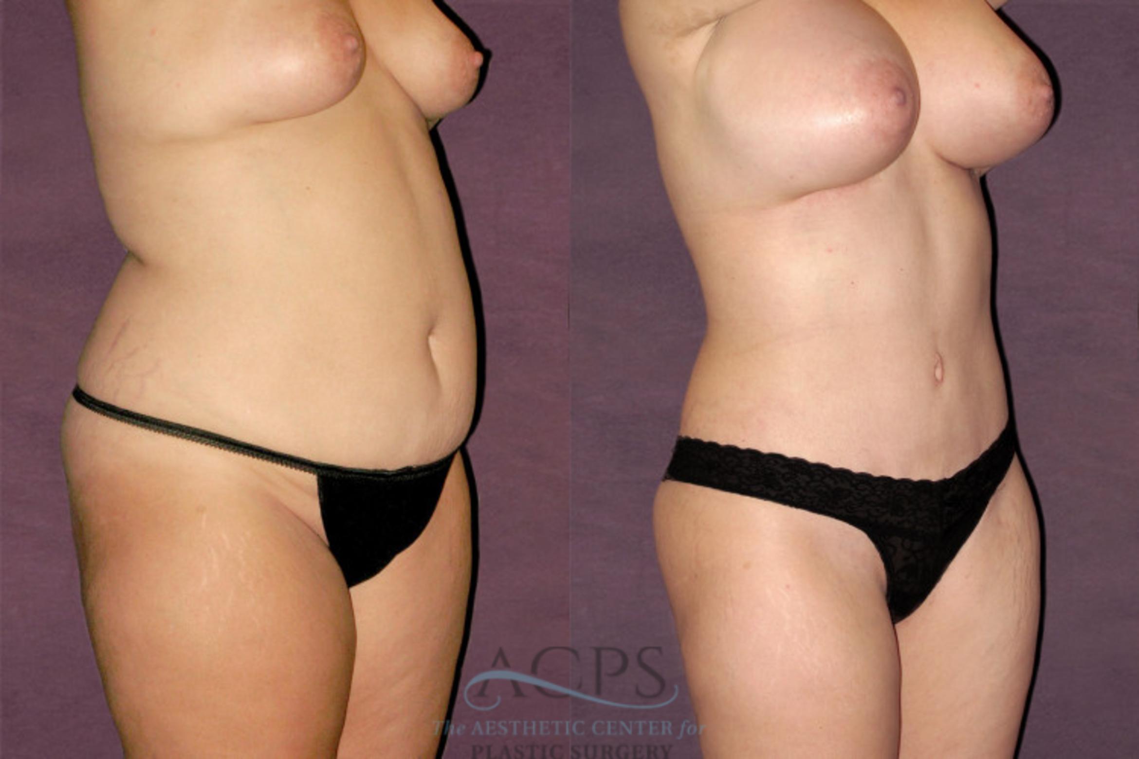 Before & After Liposuction Case 115 Oblique Right View: View in Houston, TX