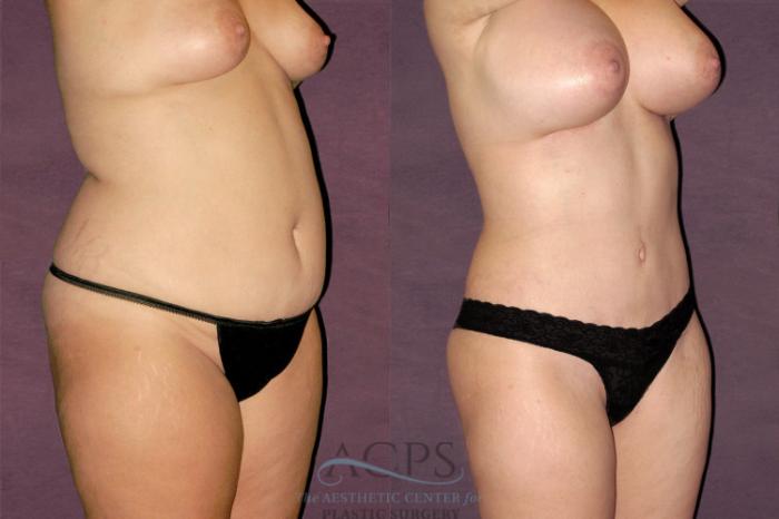 Before & After Liposuction Case 115 Oblique Right View: View in Houston, TX