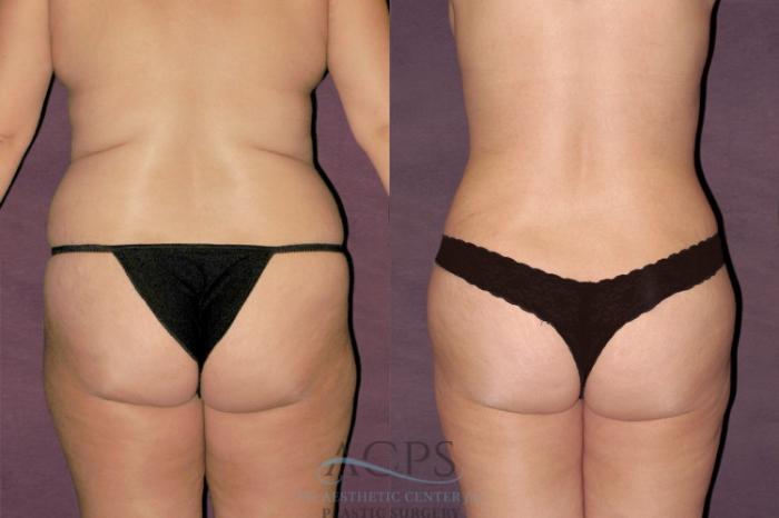 Before & After Liposuction Case 115 Rear View: View in Houston, TX