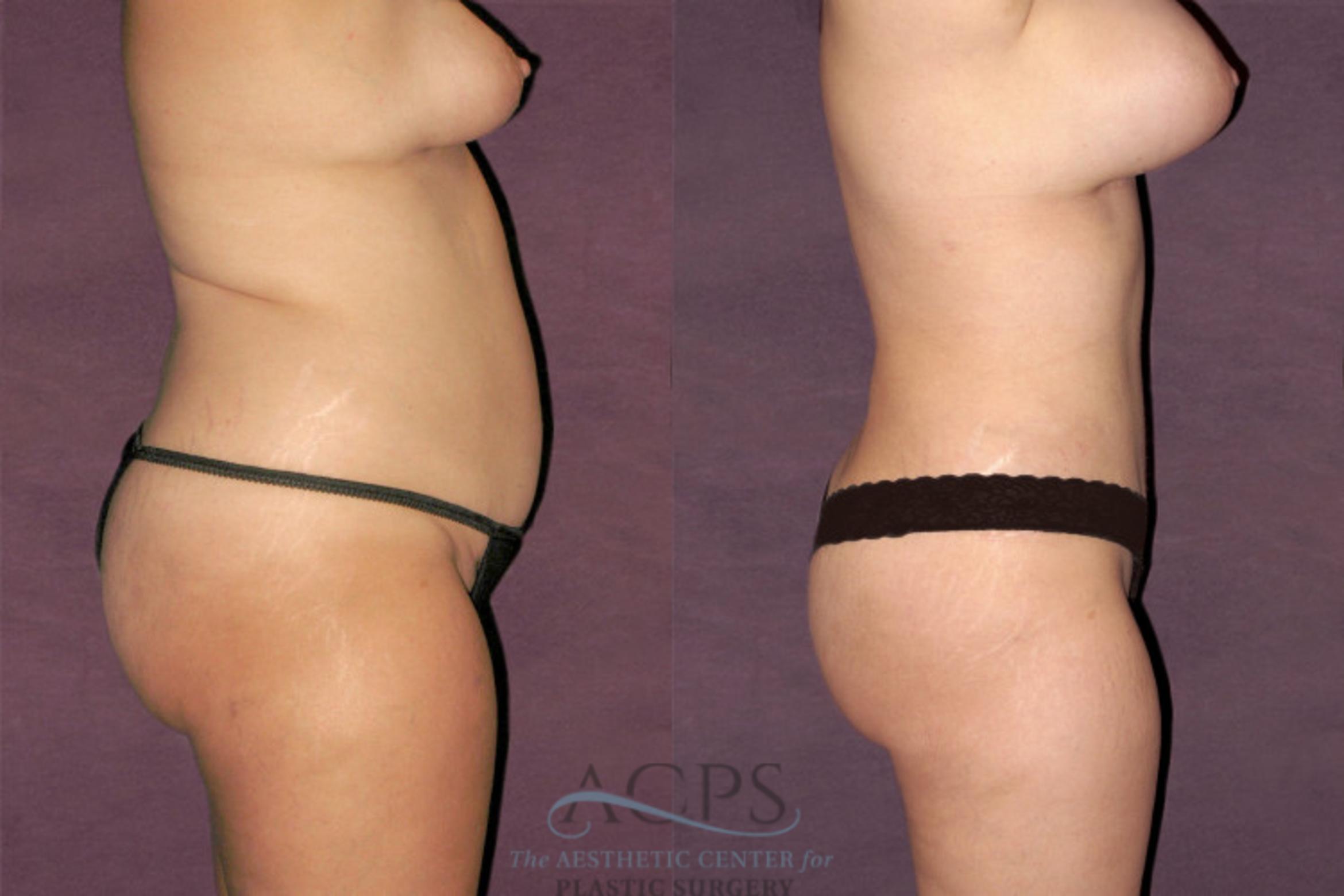 Before & After Liposuction Case 115 Side Right View: View in Houston, TX