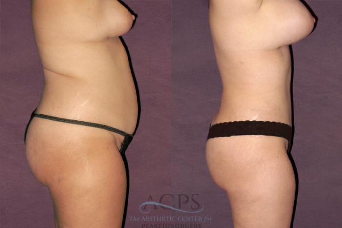 Before & After Liposuction Case 115 Side Right View: View in Houston, TX