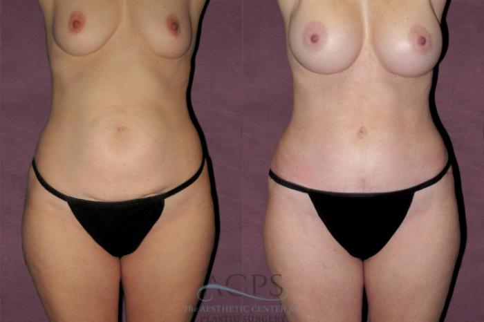 Before & After Tummy Tuck Case 116 Front View: View in Houston, TX