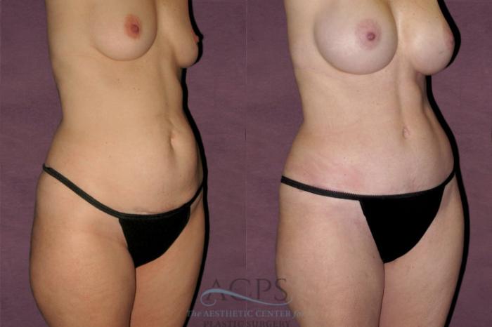 Before & After Tummy Tuck Case 116 Oblique Right View: View in Houston, TX
