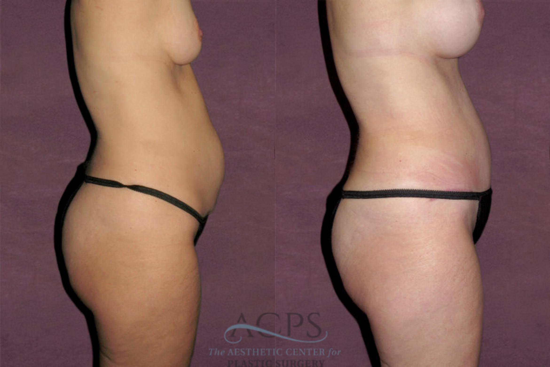 Before & After Tummy Tuck Case 116 Side Right View: View in Houston, TX