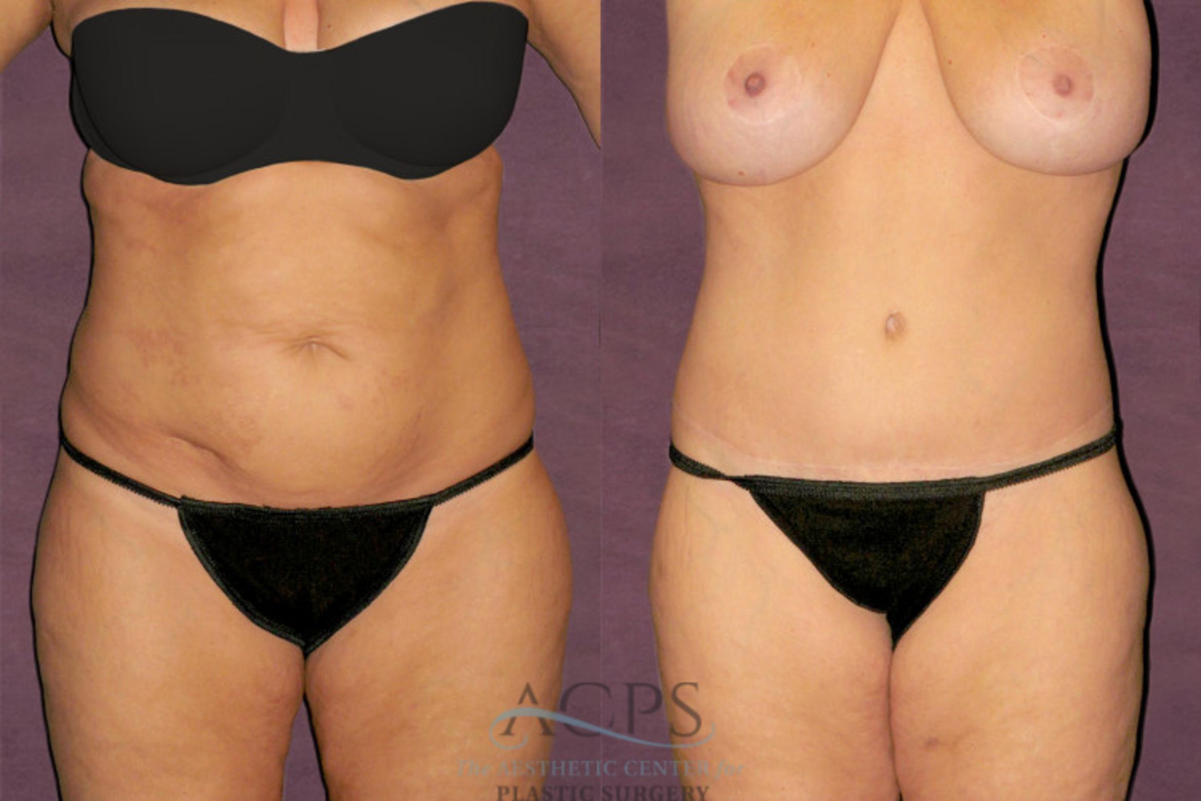 Before & After Tummy Tuck Case 117 Front View: View in Houston, TX