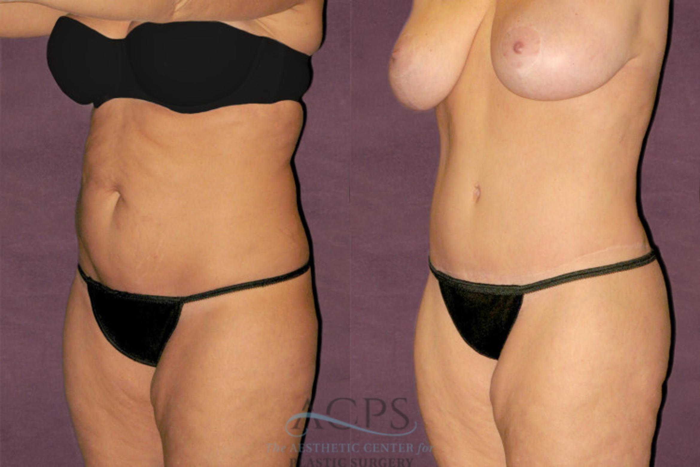 Before & After Tummy Tuck Case 117 Oblique Left View: View in Houston, TX