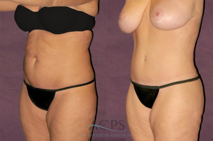 Before & After Tummy Tuck Case 117 Oblique Left View: View in Houston, TX