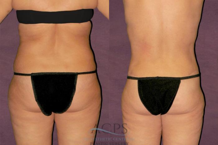 Before & After Tummy Tuck Case 117 Rear View: View in Houston, TX