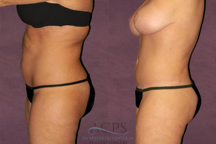 Before & After Tummy Tuck Case 117 Side Left View: View in Houston, TX