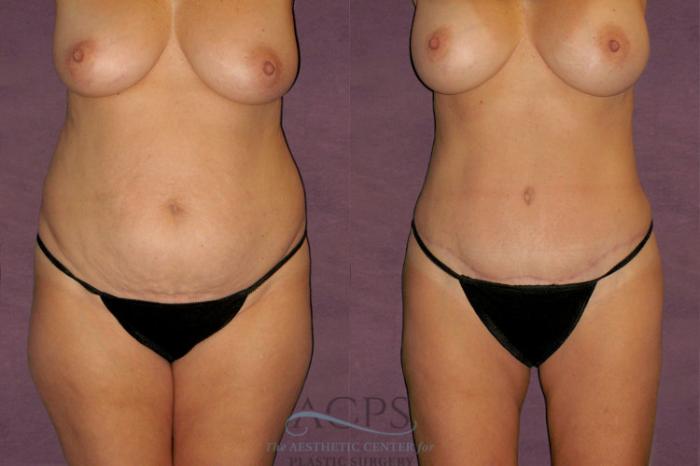 Before & After Liposuction Case 118 Front View: View in Houston, TX