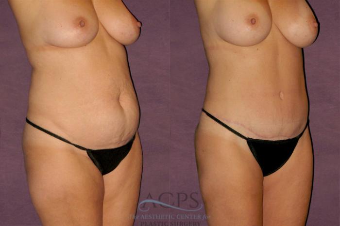 Before & After Liposuction Case 118 Oblique Right View: View in Houston, TX