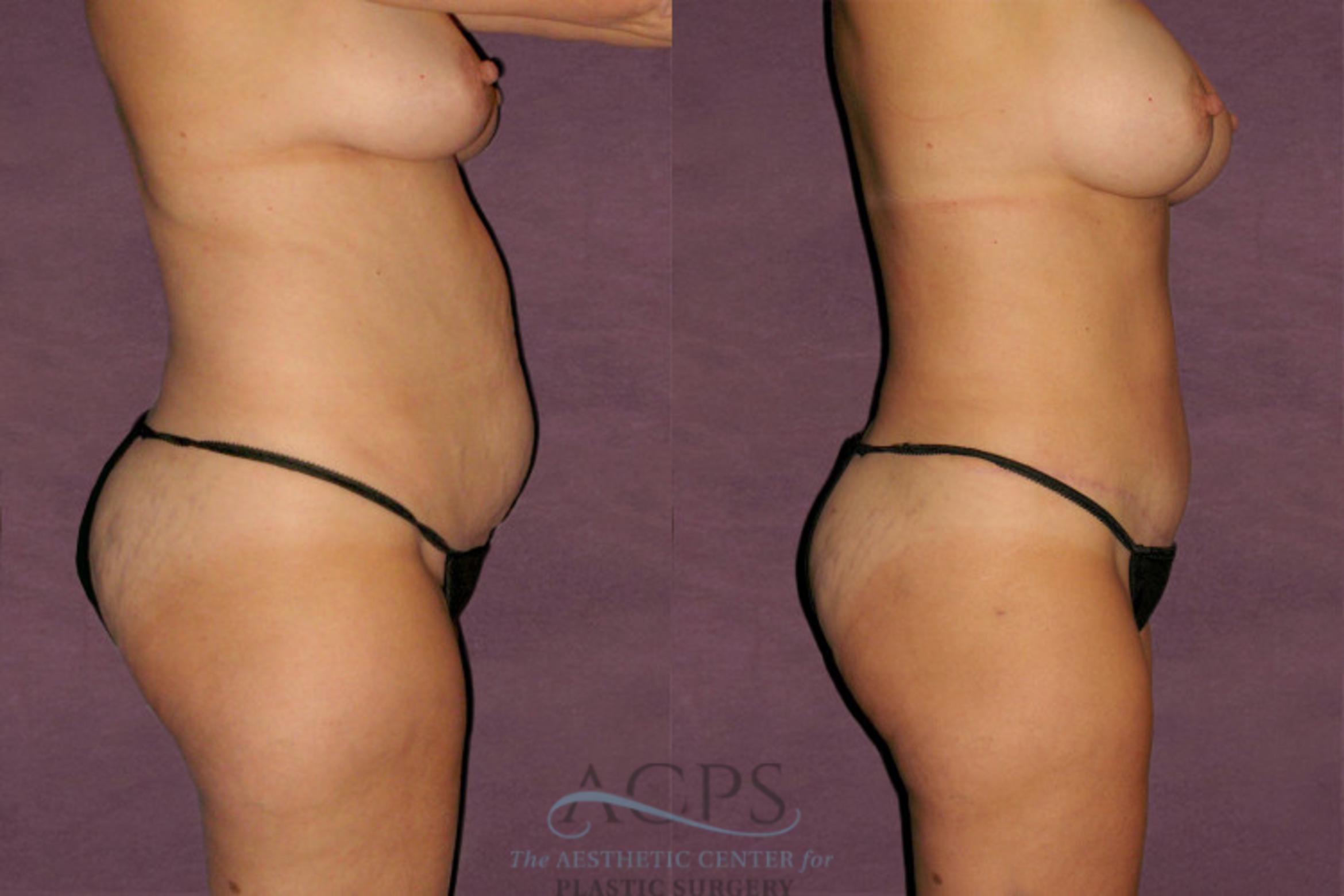 Before & After Liposuction Case 118 Side Right View: View in Houston, TX