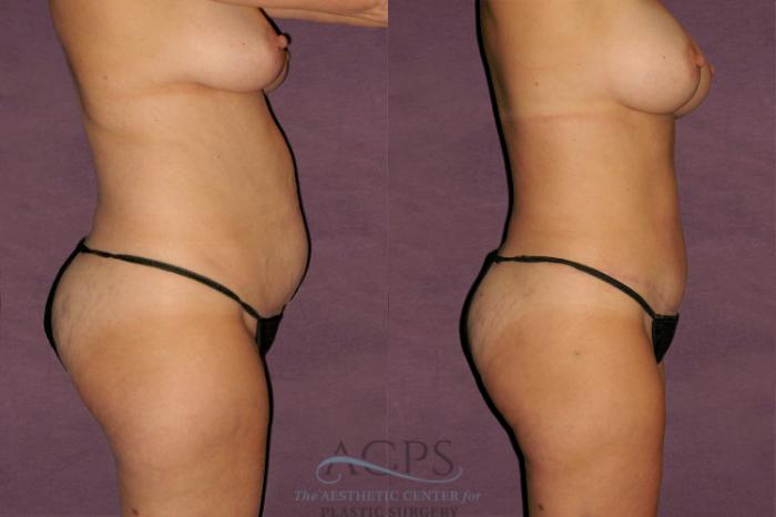 Before & After Liposuction Case 118 Side Right View: View in Houston, TX