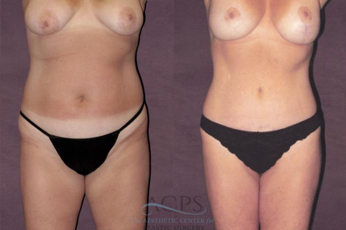 Before & After Tummy Tuck Case 119 Front View: View in Houston, TX