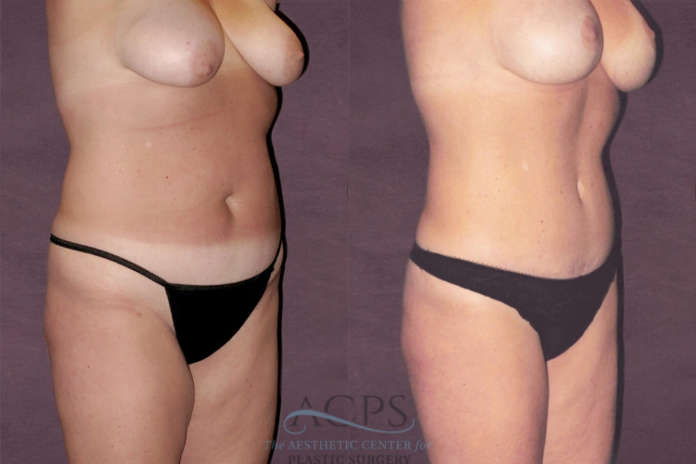 Before & After Tummy Tuck Case 119 Oblique Right View: View in Houston, TX