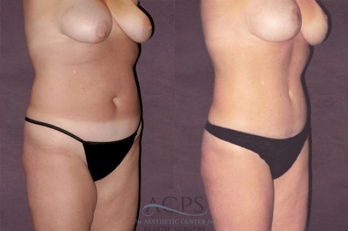 Before & After Tummy Tuck Case 119 Oblique Right View: View in Houston, TX