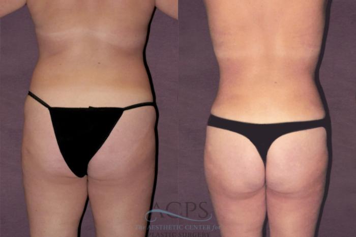 Before & After Tummy Tuck Case 119 Rear View: View in Houston, TX