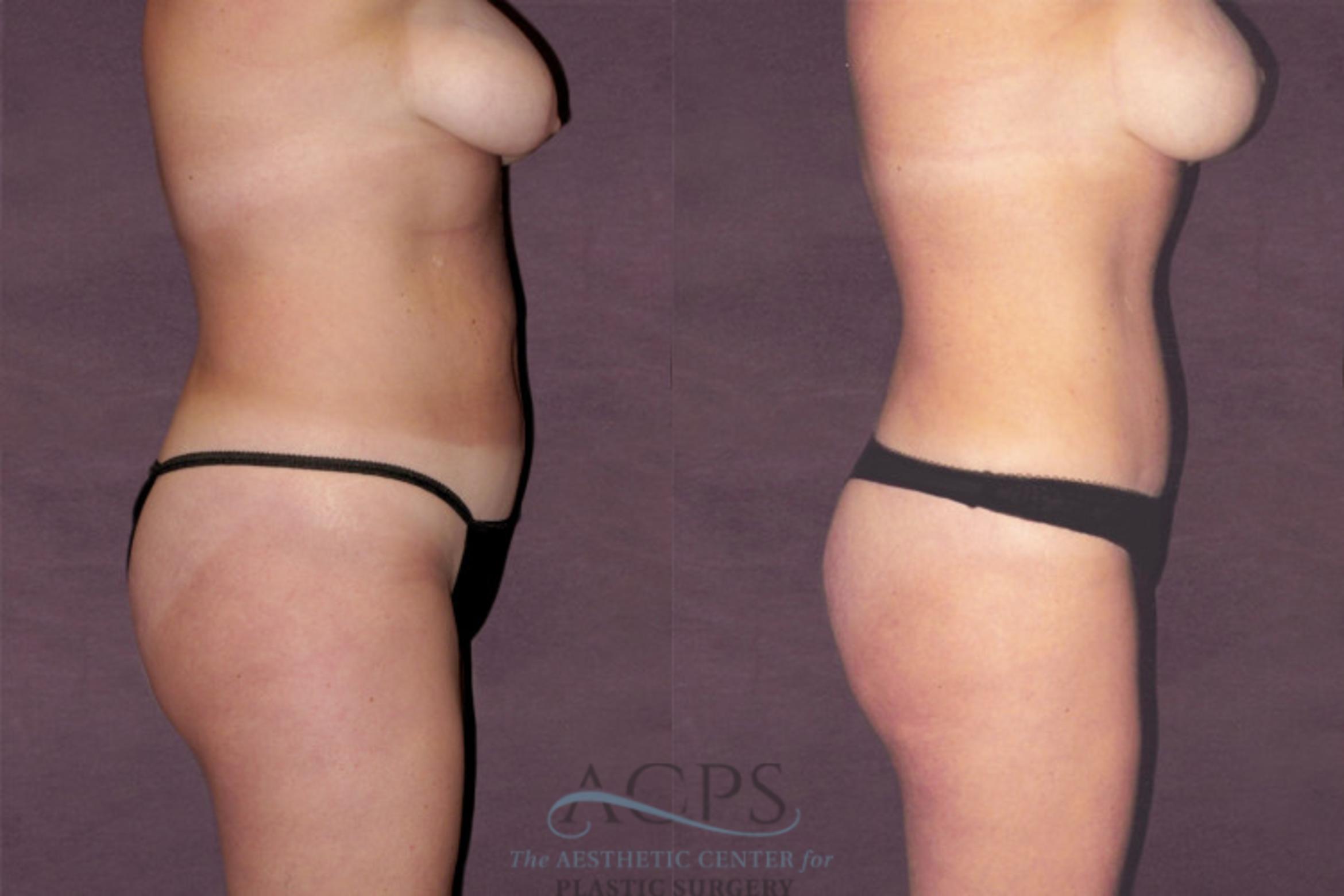 Before & After Tummy Tuck Case 119 Side Right View: View in Houston, TX