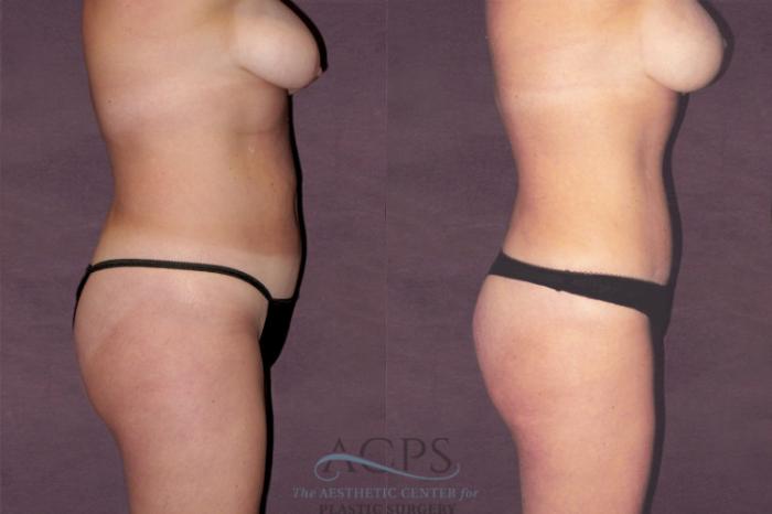 Before & After Tummy Tuck Case 119 Side Right View: View in Houston, TX