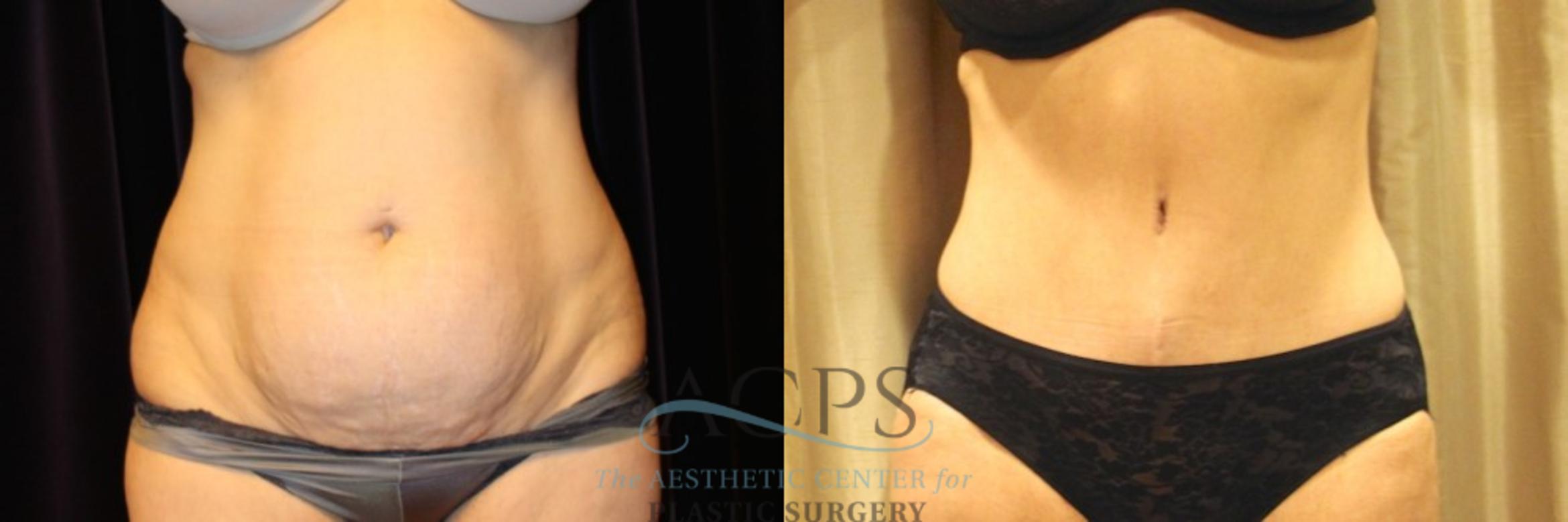 Before & After Tummy Tuck Case 12 Front View: View in Houston, TX