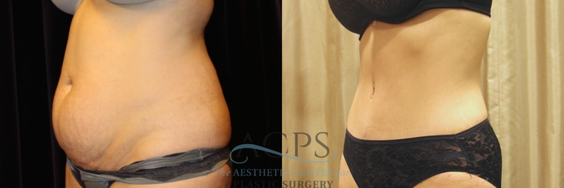 Before & After Tummy Tuck Case 12 Oblique View: View in Houston, TX