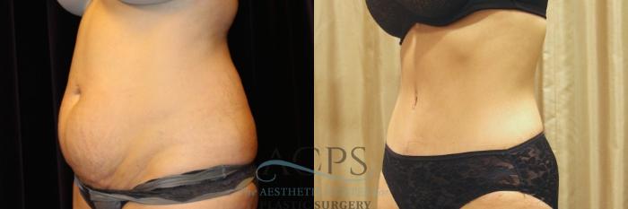 Before & After Tummy Tuck Case 12 Oblique View: View in Houston, TX