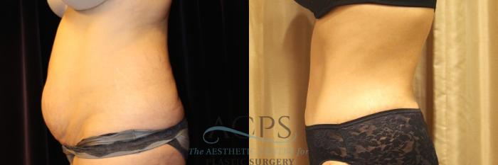 Before & After Tummy Tuck Case 12 Side View: View in Houston, TX