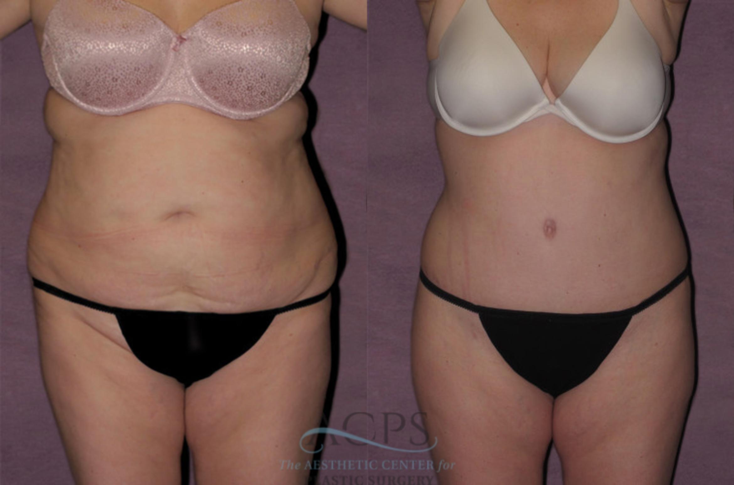 Before & After Tummy Tuck Case 121 Front View: View in Houston, TX