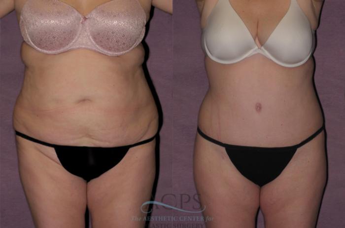 Before & After Tummy Tuck Case 121 Front View: View in Houston, TX