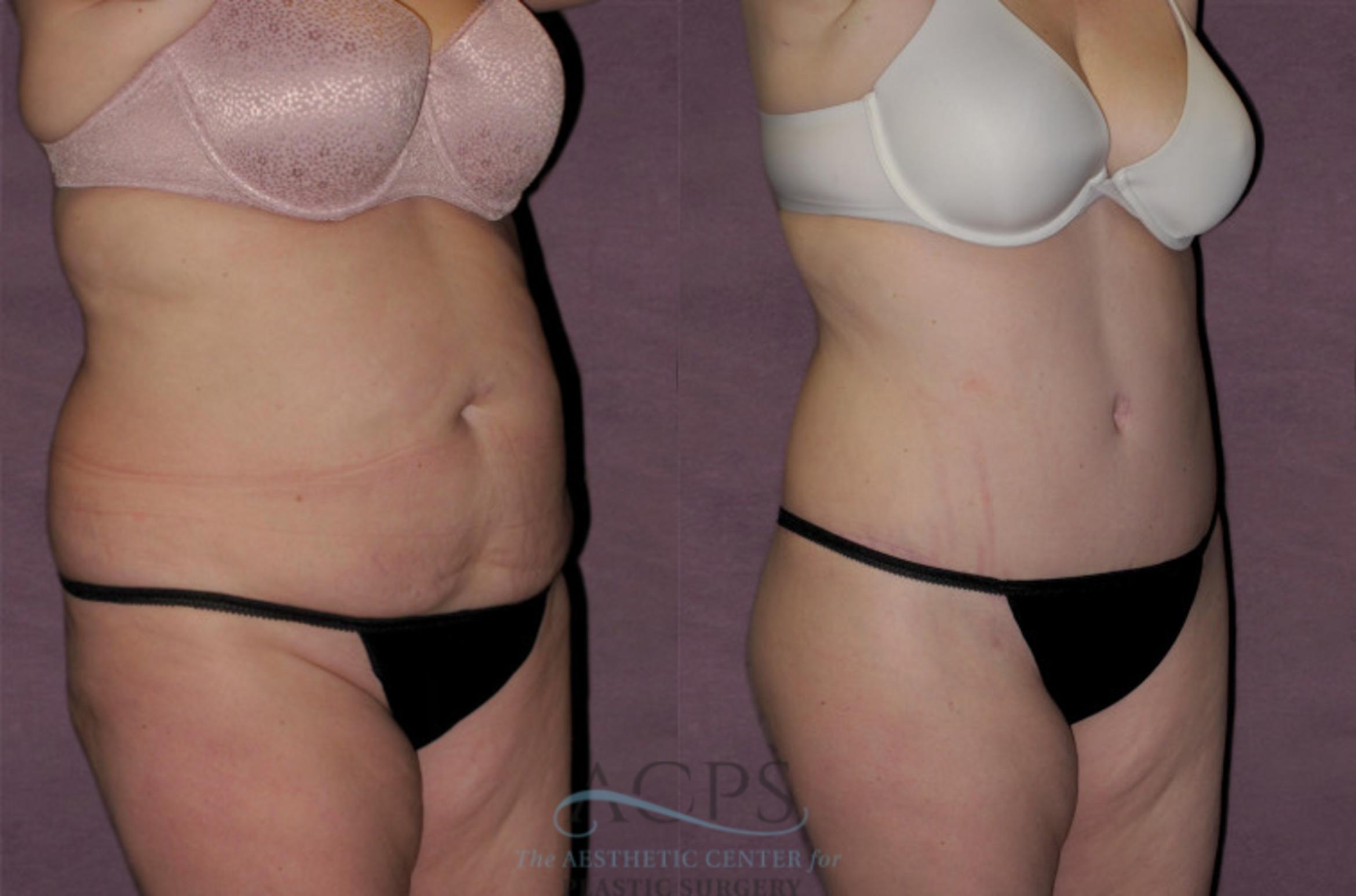 Before & After Tummy Tuck Case 121 Oblique Right View: View in Houston, TX