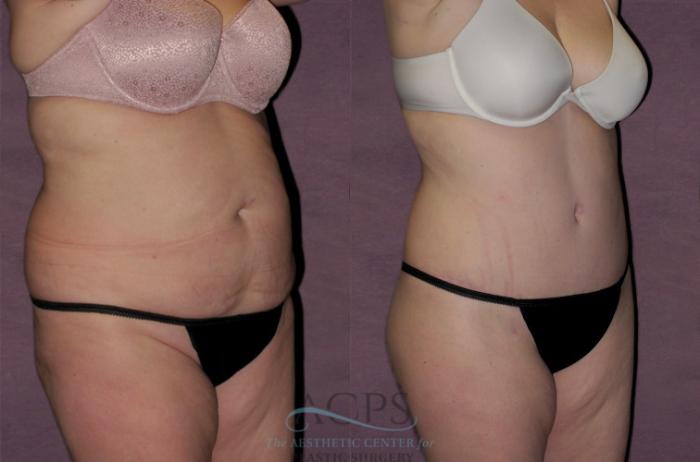 Before & After Tummy Tuck Case 121 Oblique Right View: View in Houston, TX