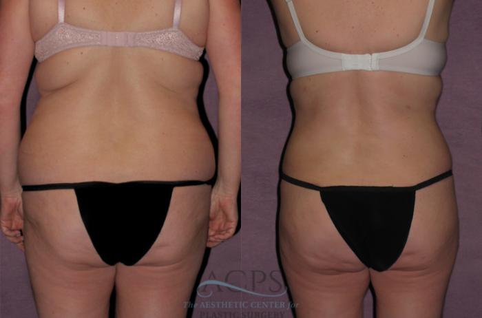 Before & After Tummy Tuck Case 121 Rear View: View in Houston, TX