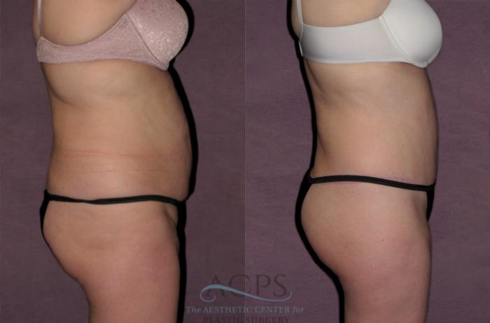 Before & After Tummy Tuck Case 121 Side Right View: View in Houston, TX