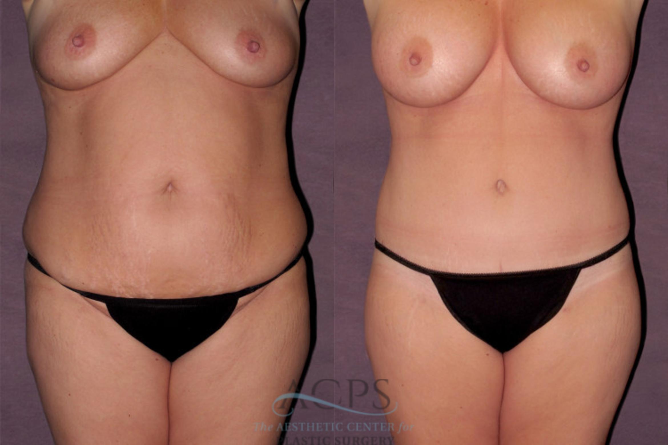 Before & After Tummy Tuck Case 122 Front View: View in Houston, TX