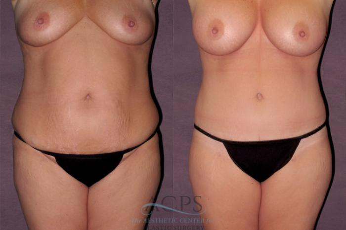 Before & After Mommy Makeover Case 122 Front View: View in Houston, TX