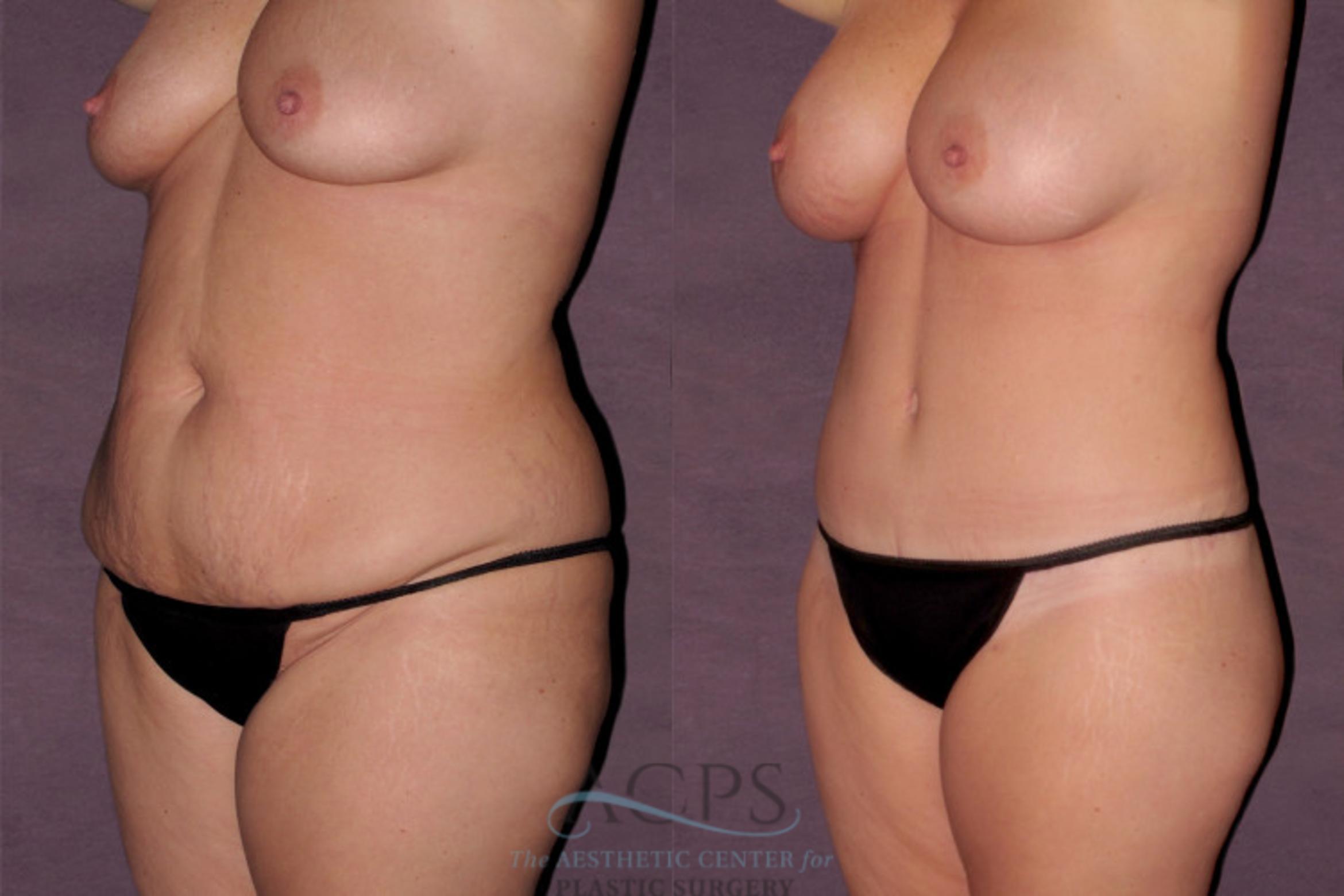 Before & After Mommy Makeover Case 122 Oblique Left View: View in Houston, TX