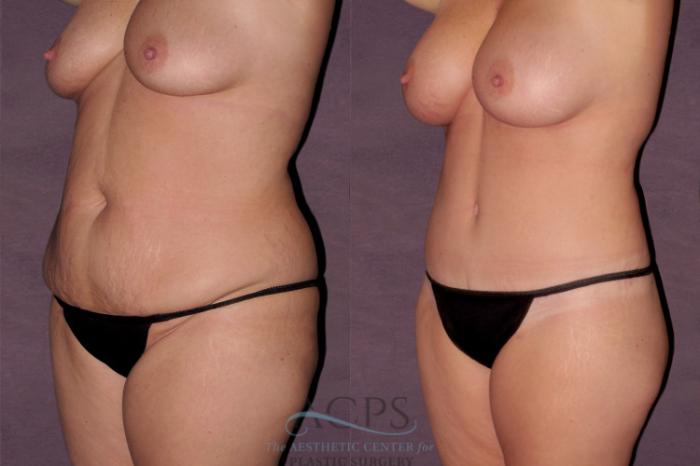 Before & After Mommy Makeover Case 122 Oblique Left View: View in Houston, TX