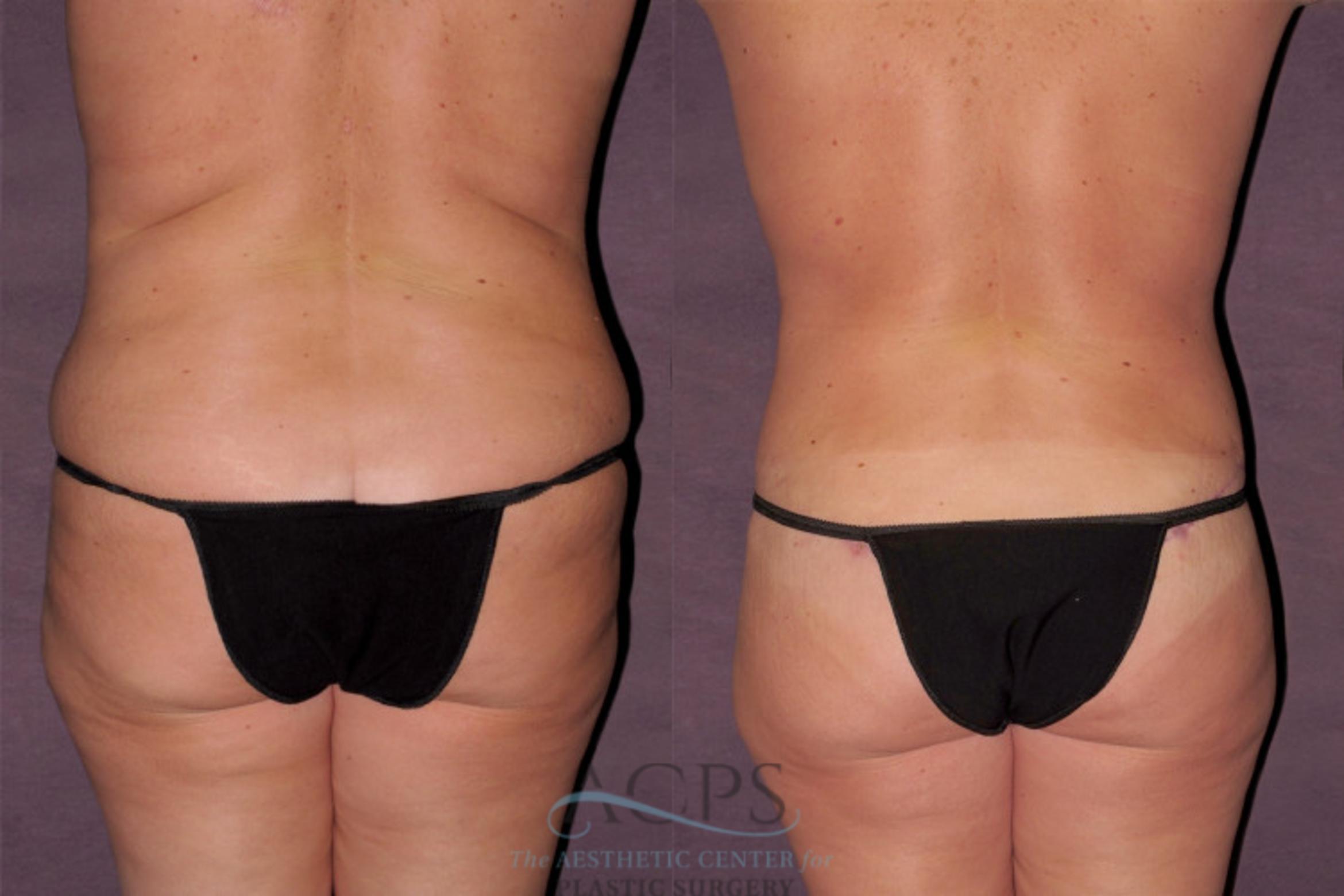 Before & After Mommy Makeover Case 122 Rear View: View in Houston, TX