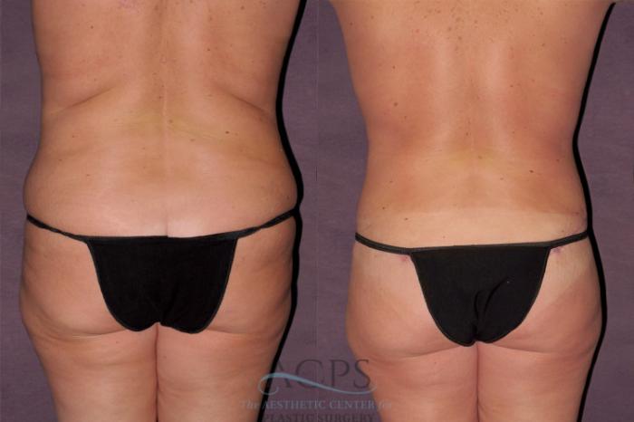 Before & After Mommy Makeover Case 122 Rear View: View in Houston, TX