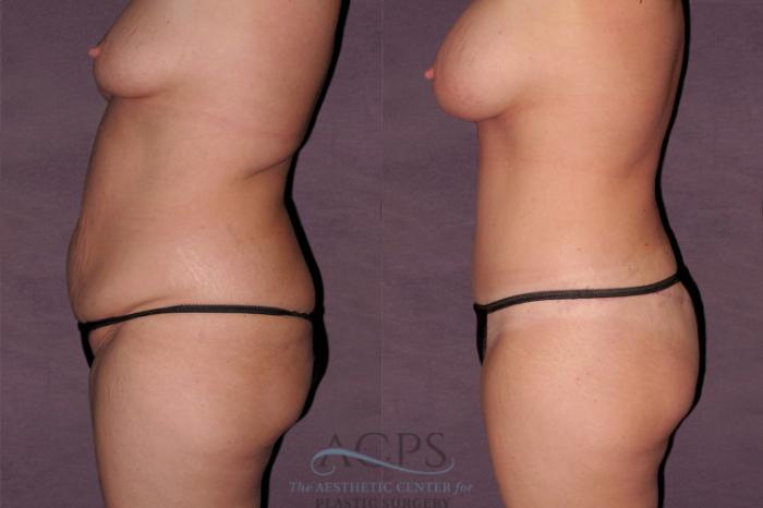 Before & After Mommy Makeover Case 122 Side Left View: View in Houston, TX