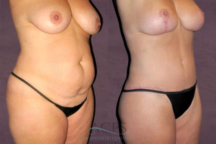 Before & After Tummy Tuck Case 123 Oblique Right View: View in Houston, TX