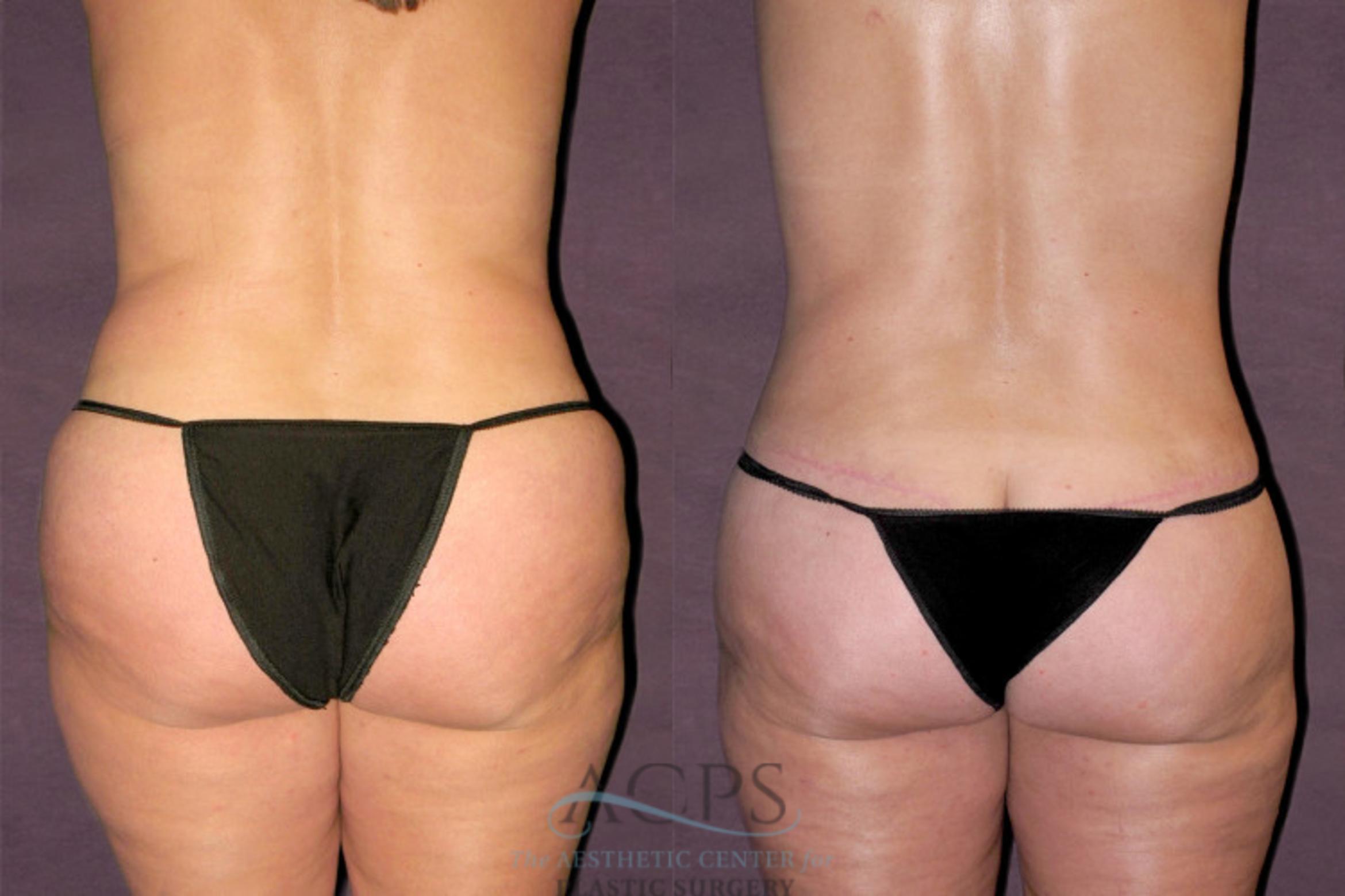 Before & After Tummy Tuck Case 123 Rear View: View in Houston, TX
