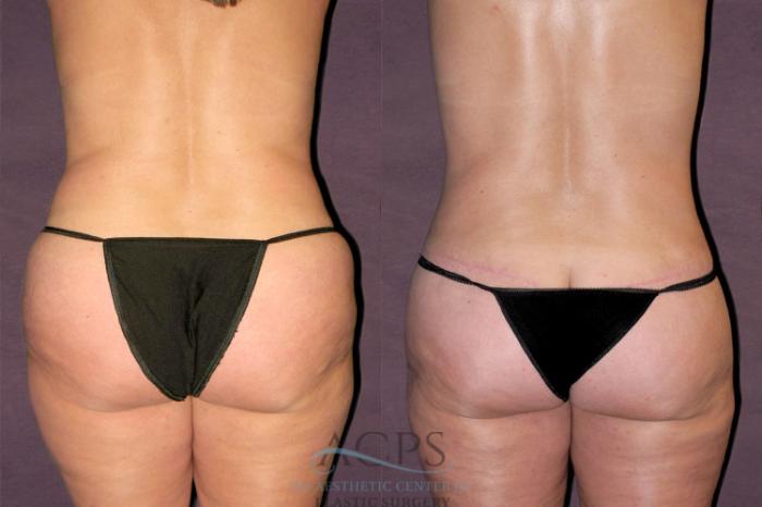 Before & After Tummy Tuck Case 123 Rear View: View in Houston, TX