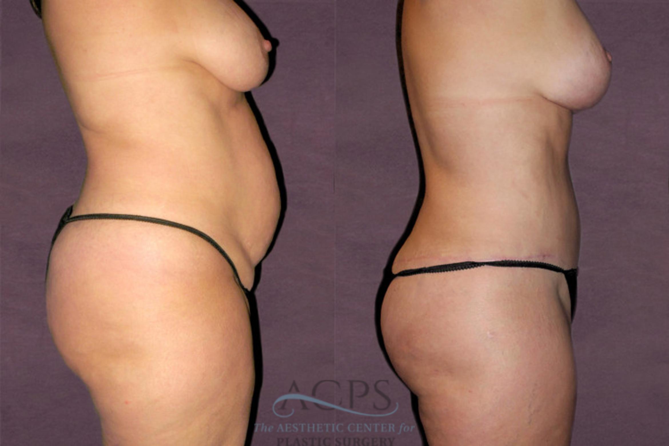Before & After Tummy Tuck Case 123 Side Right View: View in Houston, TX