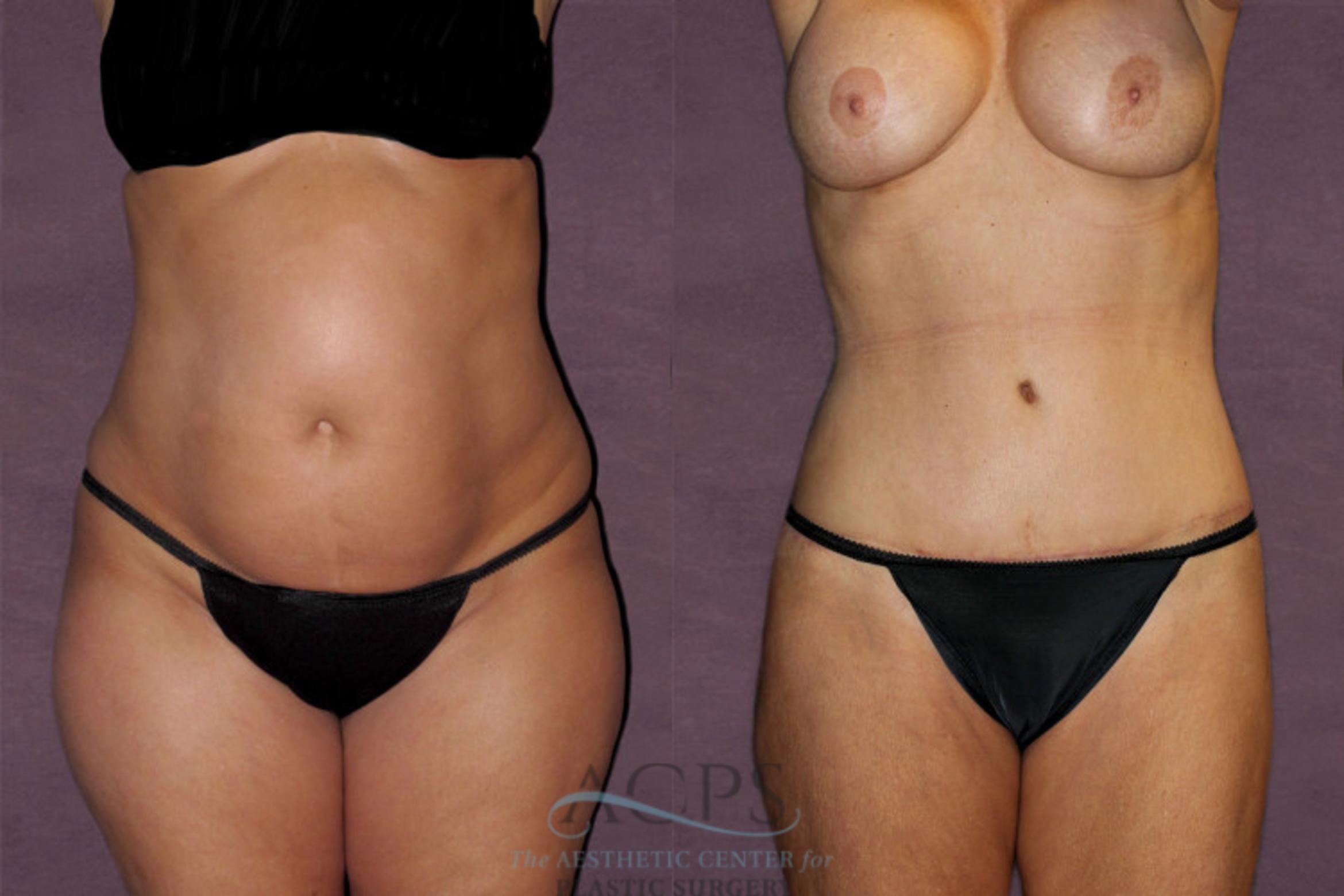 Before & After Liposuction Case 125 Front View: View in Houston, TX