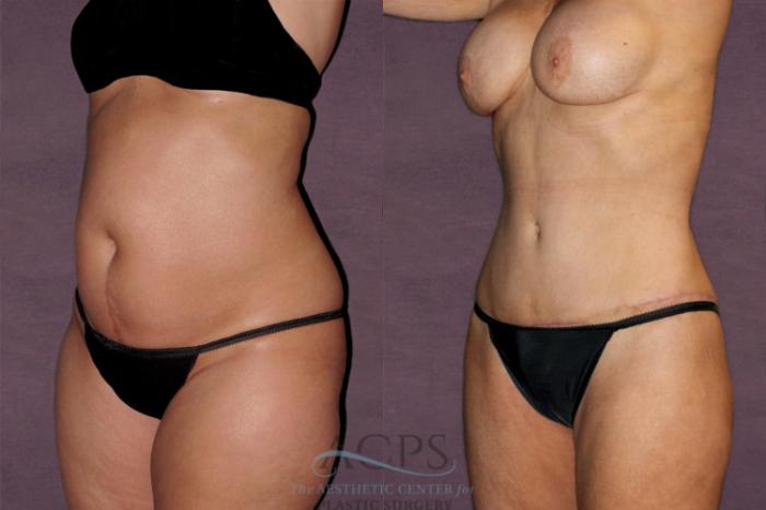 Before & After Liposuction Case 125 Oblique Left View: View in Houston, TX