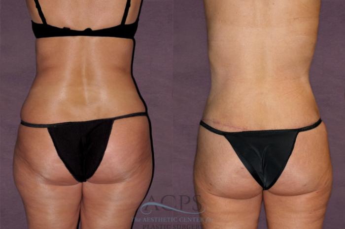 Before & After Liposuction Case 125 Rear View: View in Houston, TX