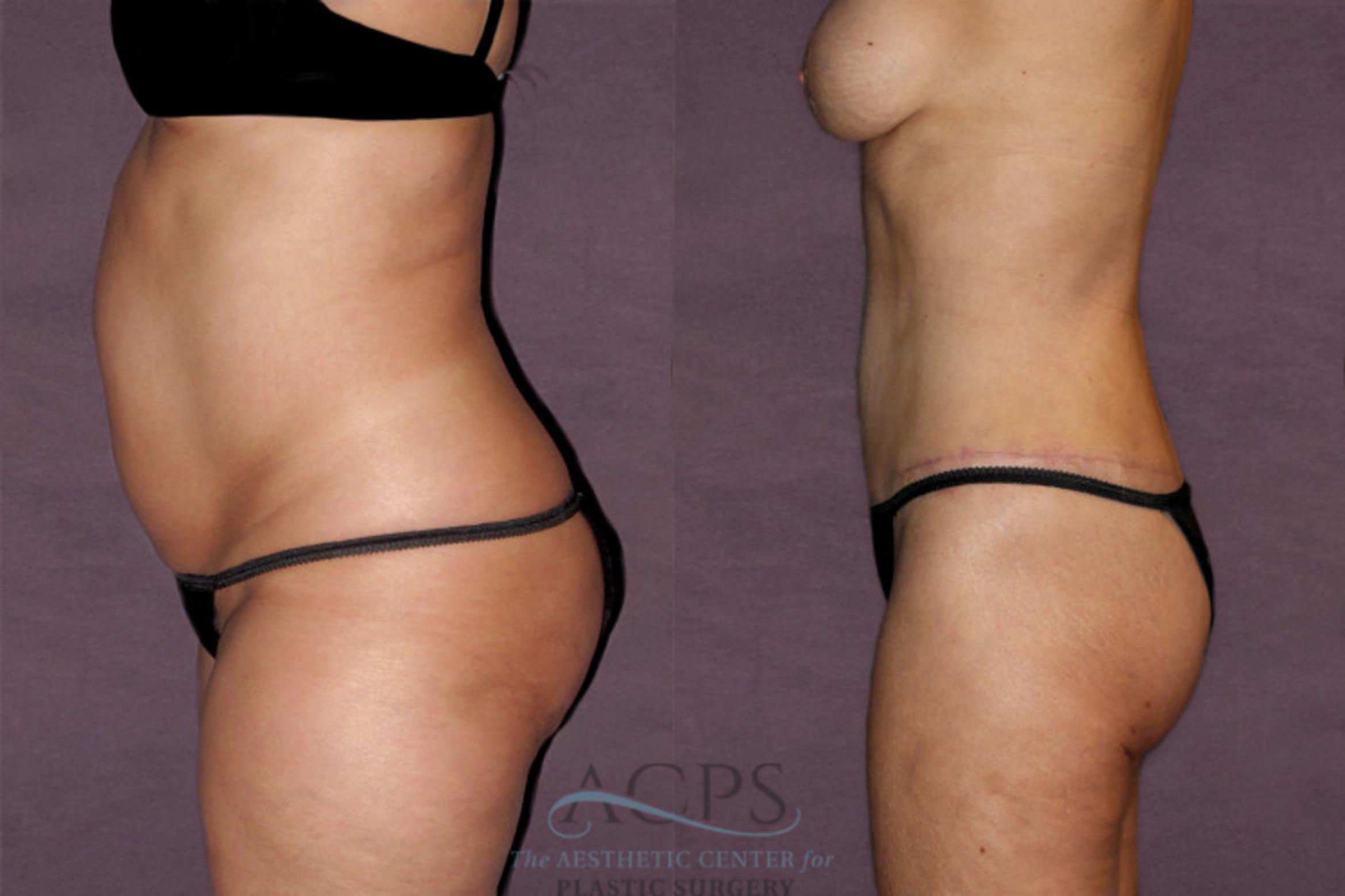 Before & After Liposuction Case 125 Side Left View: View in Houston, TX