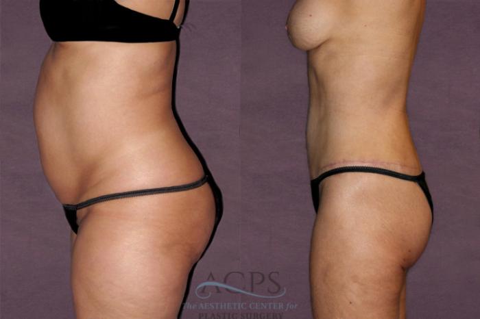 Before & After Liposuction Case 125 Side Left View: View in Houston, TX