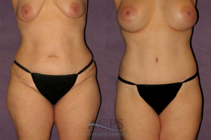 Before & After Tummy Tuck Case 126 Front View: View in Houston, TX